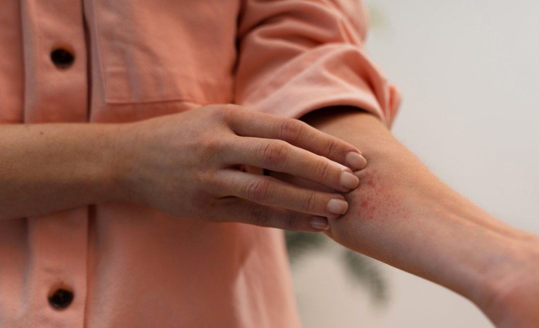 When the Skin Speaks in Rashes: A Homeopathic View on Urticaria