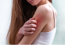 Chronic Skin Allergies